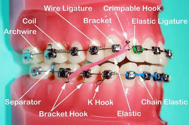 Braces Price in Bangladesh